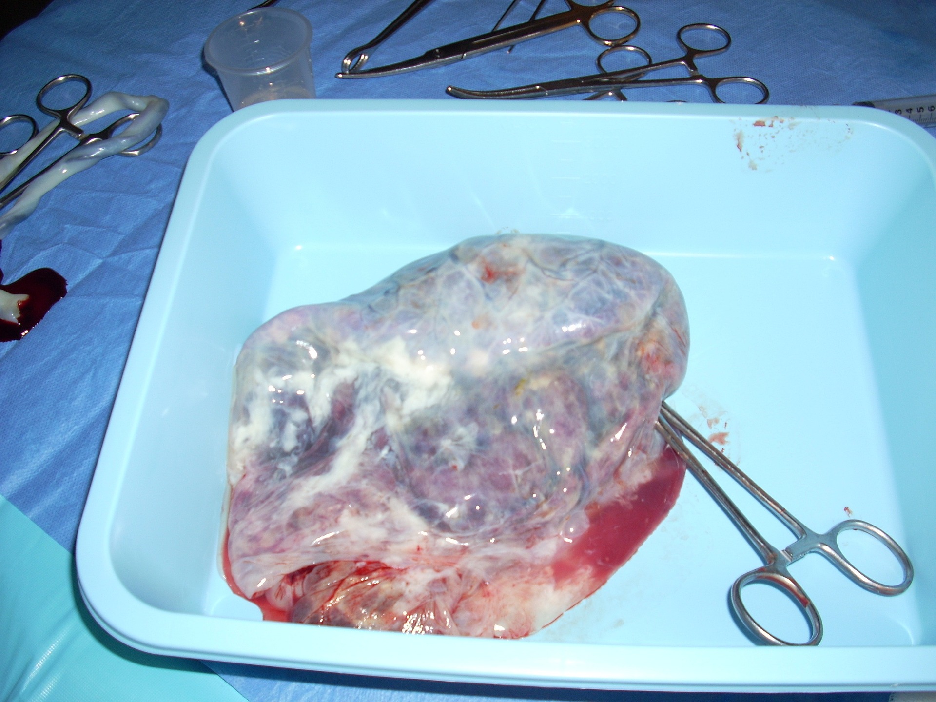 porod placenta