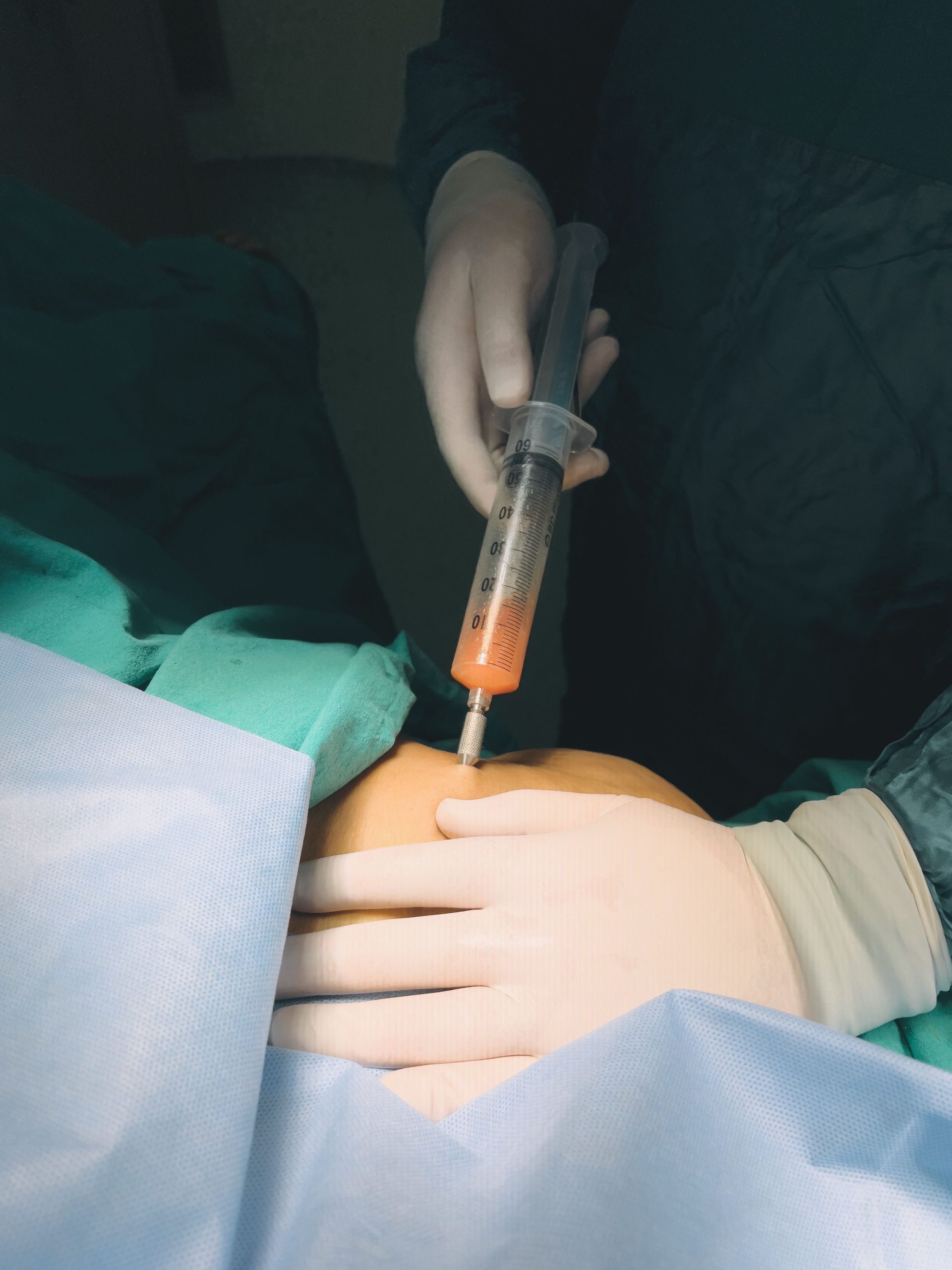 Liposukce